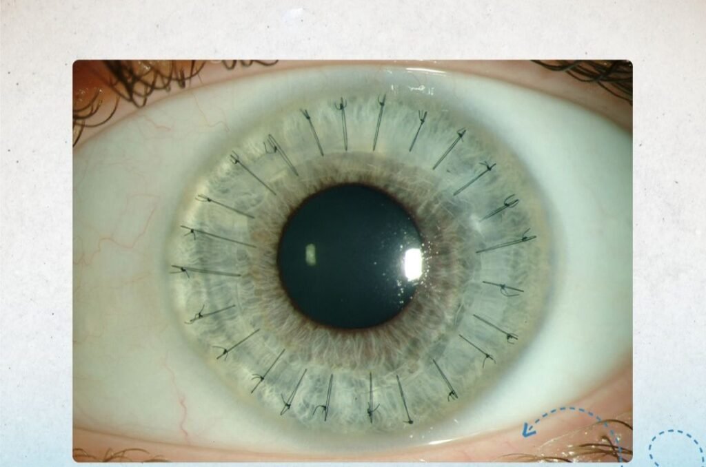 ثمانية أسئلة مع طبيب عيون