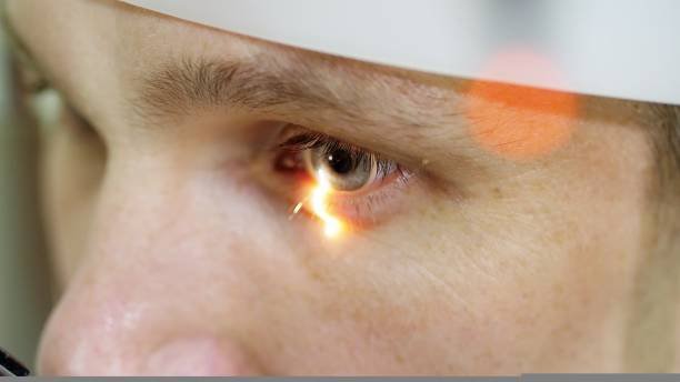 أنواع المياه البيضاء في العين