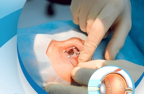 عملية المياه البيضاء بالليزر
عملية إزالة المياه البيضاء
نسبة نجاح عملية المياه البيضاء