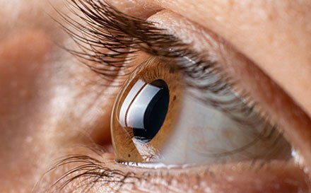 القرنية المخروطية: التشخيص والعلاج وخيارات الزراعة