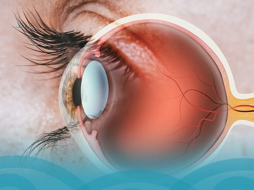 اعتلال الشبكية السكري