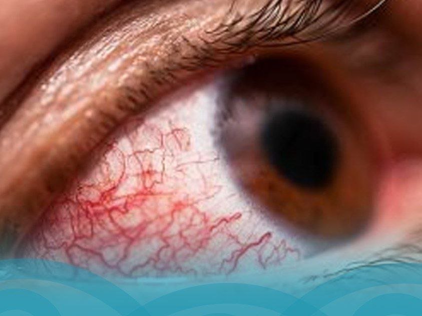 5 علامات مبكرة تكشف إصابتك باعتلال الشبكية السكري