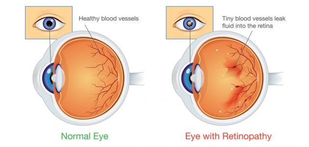 اعتلال الشبكية السكري