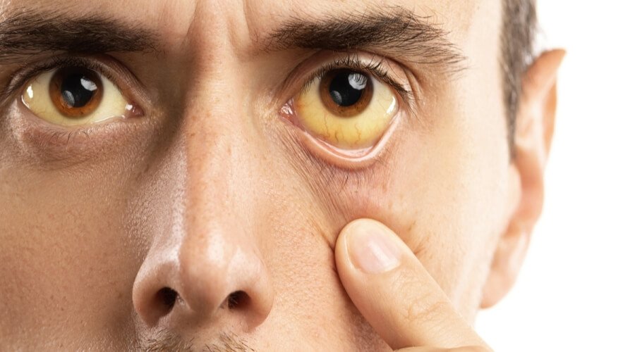 أمراض الكبد 