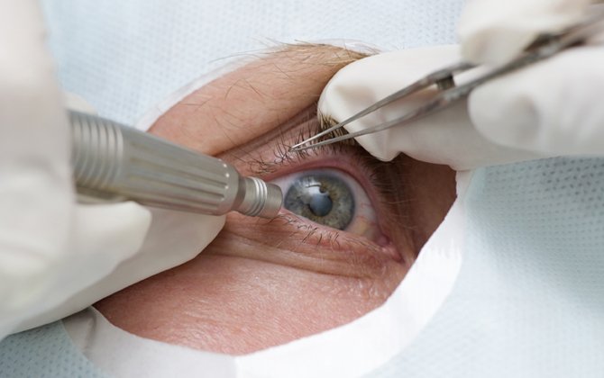 نجاح زراعة القرنية