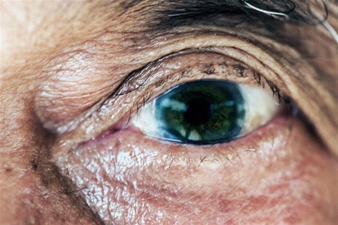 الضمور البقعي المرتبط بالعمر