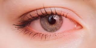 العين الوردية: الأسباب، الأعراض، وطرق الوقاية والعلاج