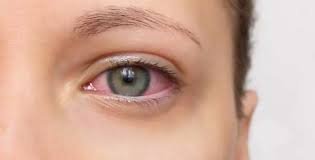 التهاب القزحية: الأسباب، الأعراض، وطرق العلاج والوقاية