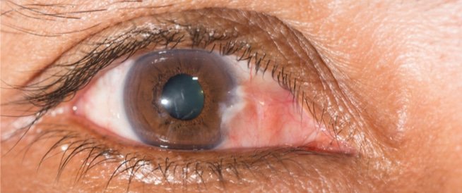 الظفرة العينية (Pterygium): الأسباب، الأعراض، وطرق الوقاية والعلاج