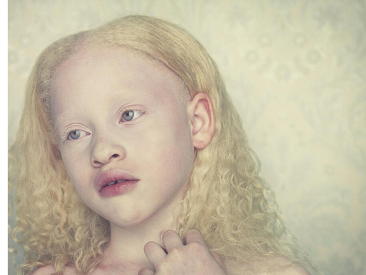 البرص العيني (المهق العيني)