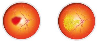 التنكس البقعي من امراض ومشاكل العيون