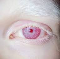 البرص العيني 
