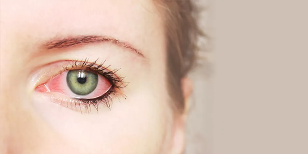 التهاب العين المزمن: الأسباب، الأعراض، وطرق العلاج