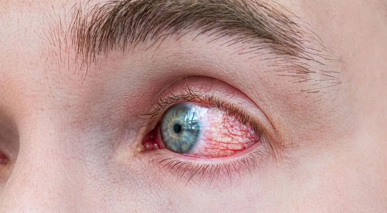 التهاب القرنية الجرثومي أم الفيروسي؟ الفرق الذي يحدد العلاج