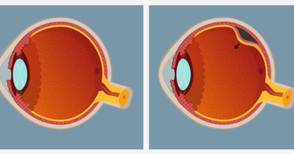 انفصال الشبكية
