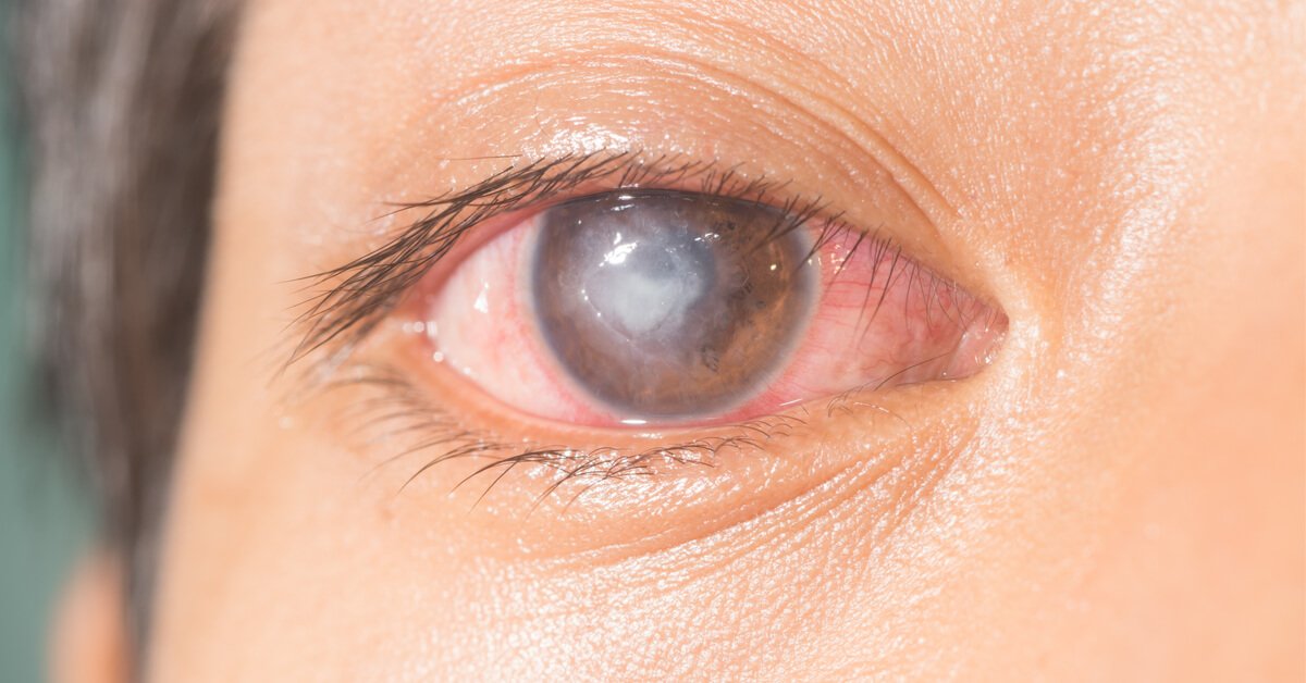 التهاب القرنية الفطري: الأعراض والتشخيص وطرق العلاج