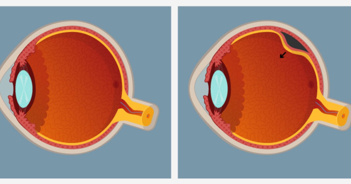 8 أعراض لانفصال الشبكية لا يجب تجاهلها: علامات تحذيرية قد تنقذ نظرك