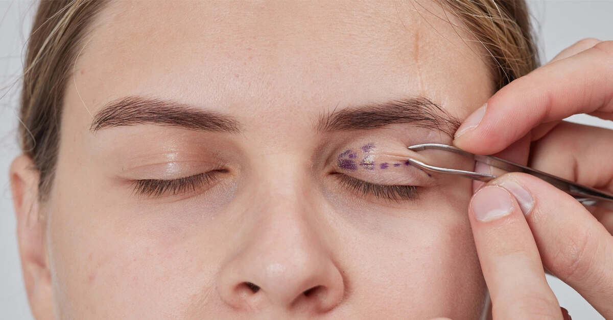 تجميل الجفون: إجراءً طبياً أم تجميلياً؟