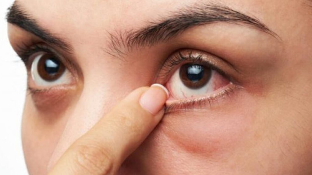 جفاف العين وارتفاع ضغط العين