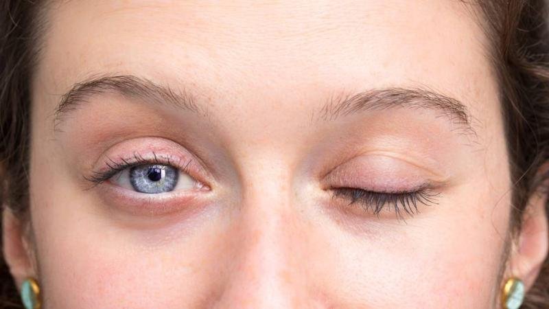 شلل عضلات العين: الأسباب العصبية وتأثيرها على الرؤية