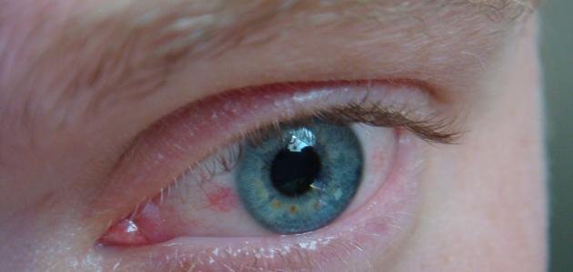 الجلوكوما وضغط العين